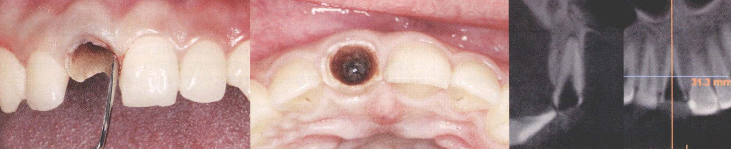 CGF凝块用于牙槽嵴保存及早期种植的临床观察